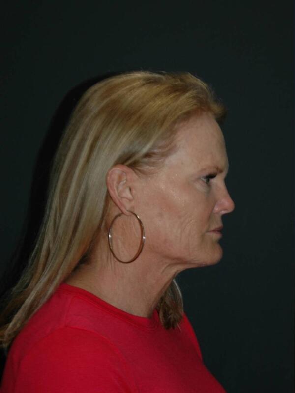 Facelift & Neck Lift Before & After Photo