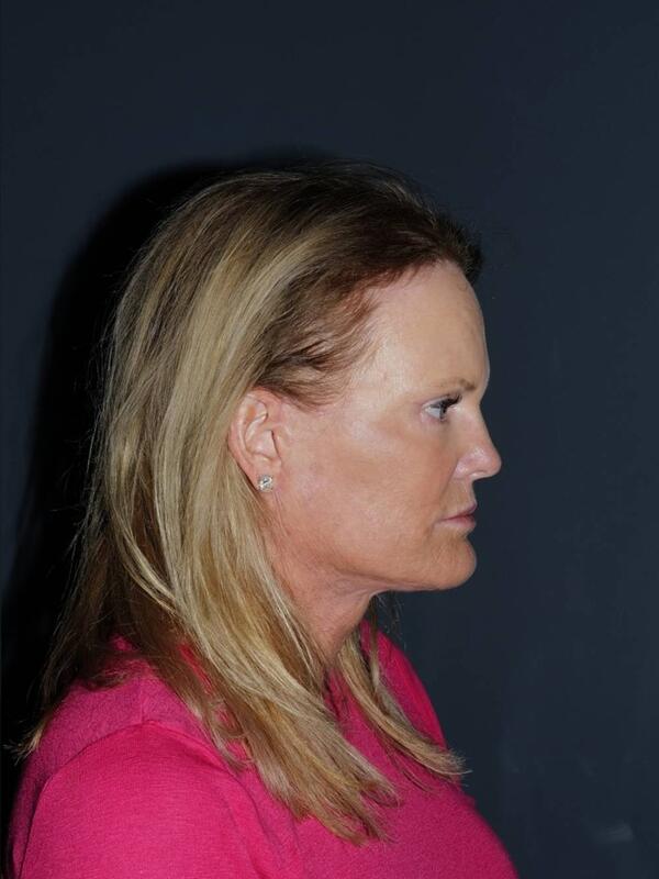 Facelift & Neck Lift Before & After Photo