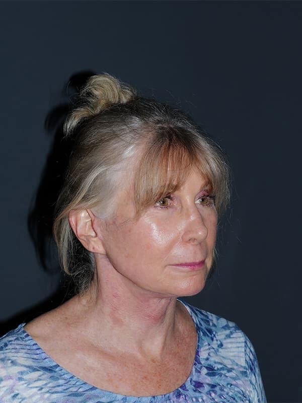 Facelift & Neck Lift Before & After Photo