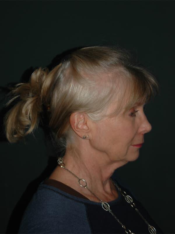 Facelift & Neck Lift Before & After Photo