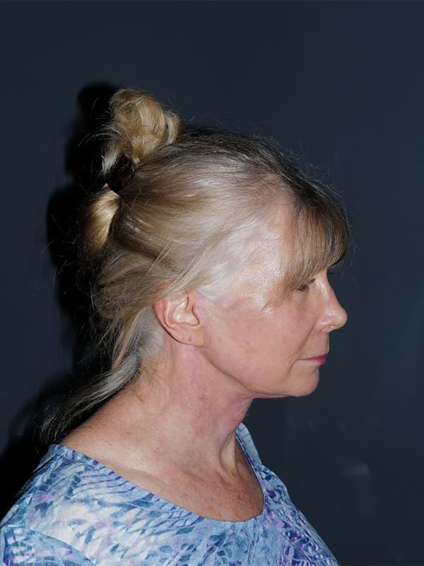 Facelift & Neck Lift Before & After Photo