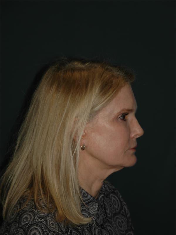 Facelift & Neck Lift Before & After Photo