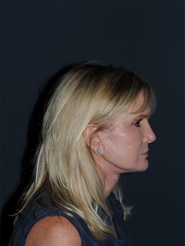 Facelift & Neck Lift Before & After Photo