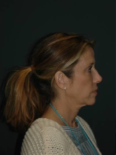 Facelift & Neck Lift Before & After Photo