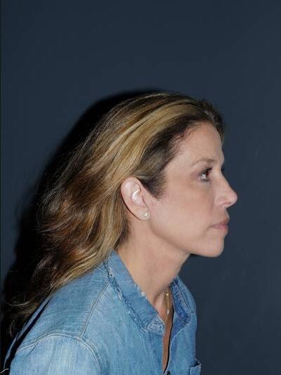 Facelift & Neck Lift Before & After Photo