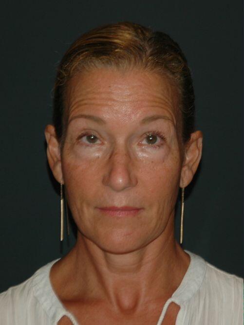 Facelift & Neck Lift Before & After Photo