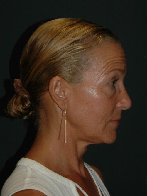 Facelift & Neck Lift Before & After Photo