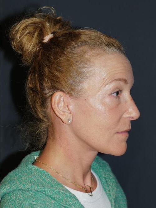 Facelift & Neck Lift Before & After Photo