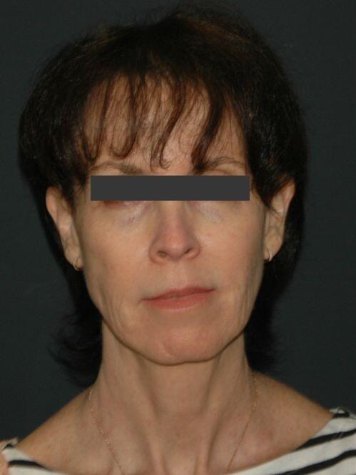 Facelift & Neck Lift Before & After Photo