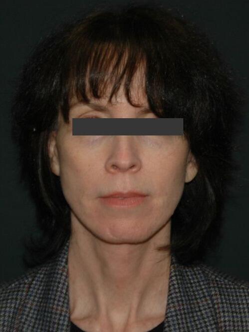 Facelift & Neck Lift Before & After Photo