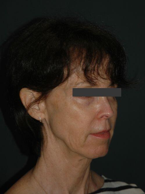 Facelift & Neck Lift Before & After Photo