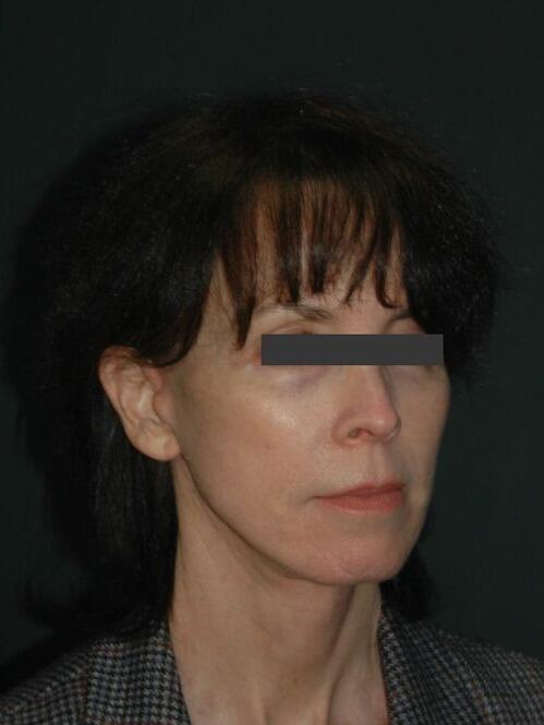 Facelift & Neck Lift Before & After Photo