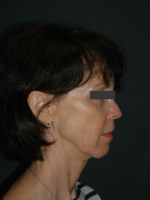 Facelift & Neck Lift Before & After Photo