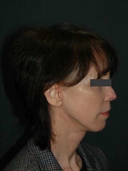 Facelift & Neck Lift Before & After Photo