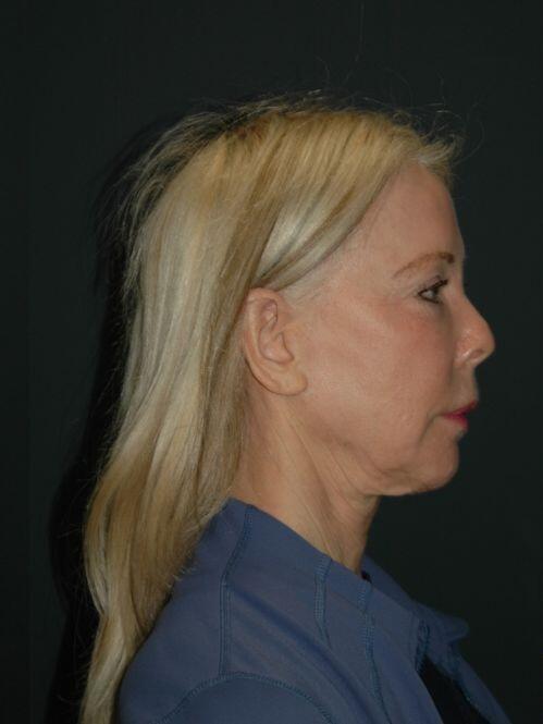 Facelift & Neck Lift Before & After Photo