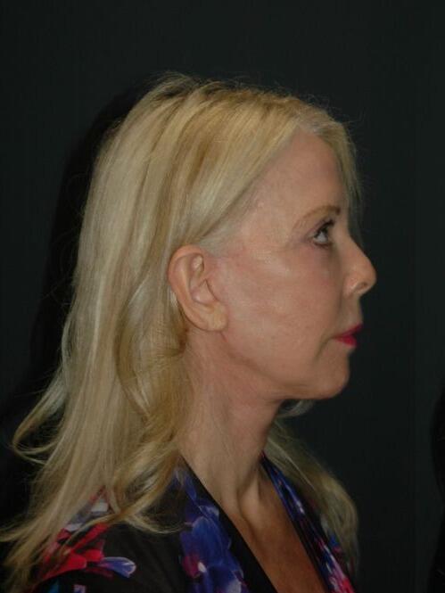 Facelift & Neck Lift Before & After Photo