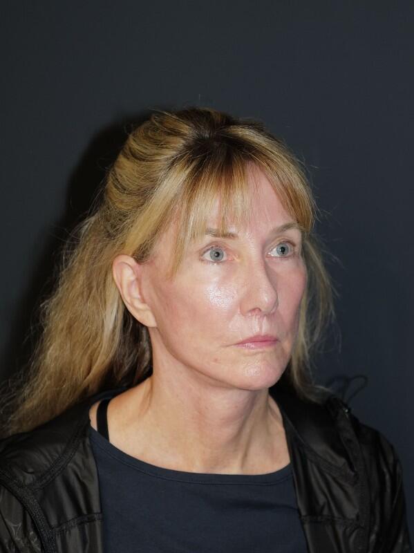 Facelift & Neck Lift Before & After Photo