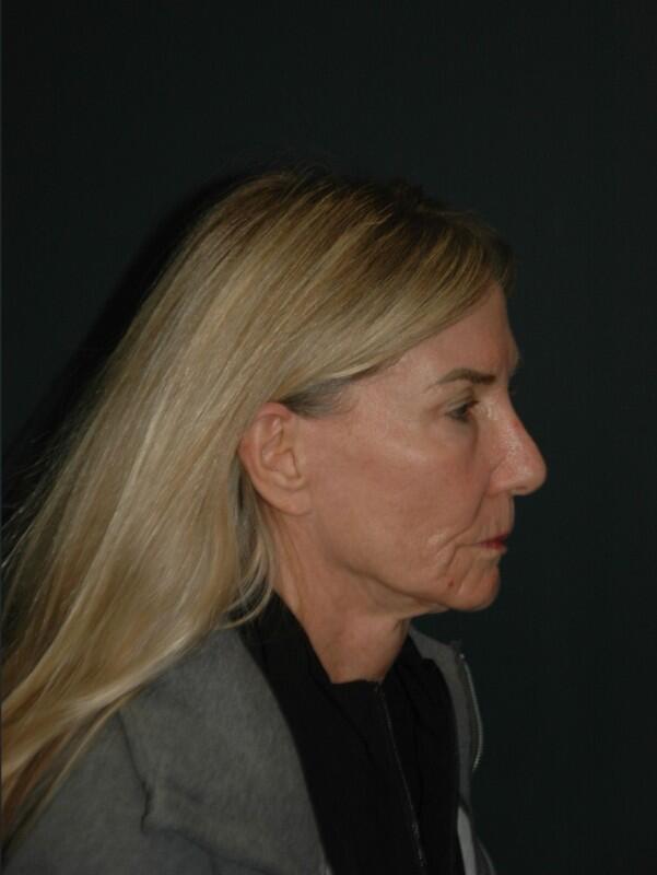 Facelift & Neck Lift Before & After Photo