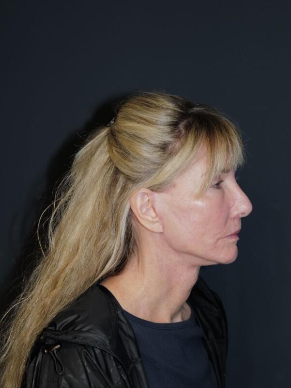 Facelift & Neck Lift Before & After Photo