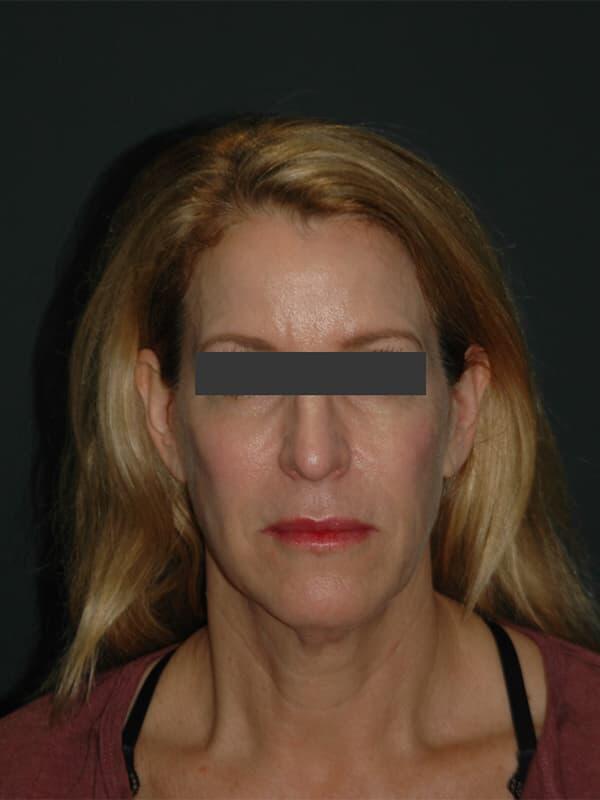 Facelift & Neck Lift Before & After Photo