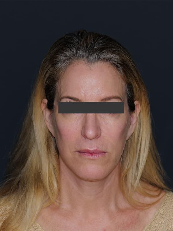 Facelift & Neck Lift Before & After Photo