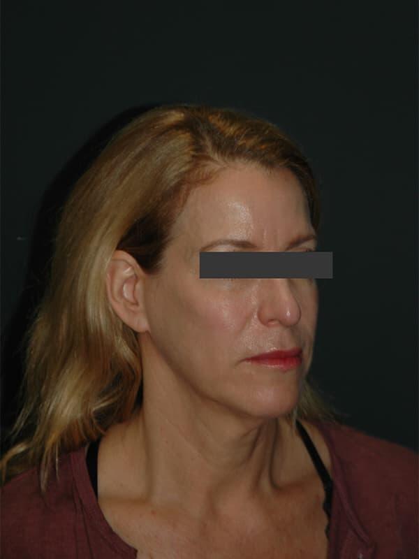 Facelift & Neck Lift Before & After Photo