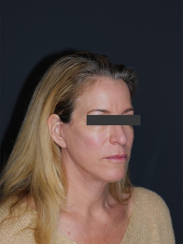 Facelift & Neck Lift Before & After Photo