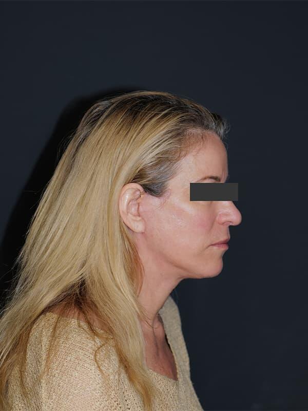 Facelift & Neck Lift Before & After Photo