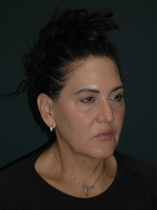 Facelift & Neck Lift Before & After Photo