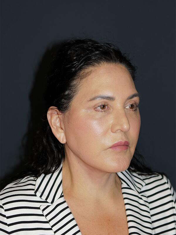 Facelift & Neck Lift Before & After Photo