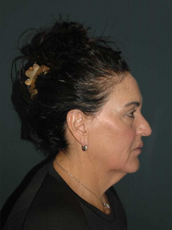 Facelift & Neck Lift Before & After Photo