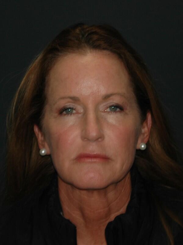 Facelift & Neck Lift Before & After Photo