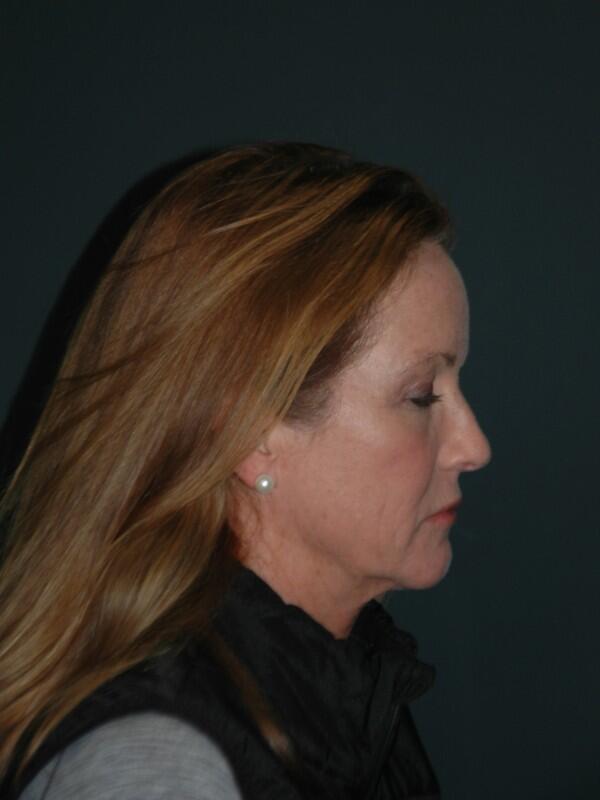 Facelift & Neck Lift Before & After Photo