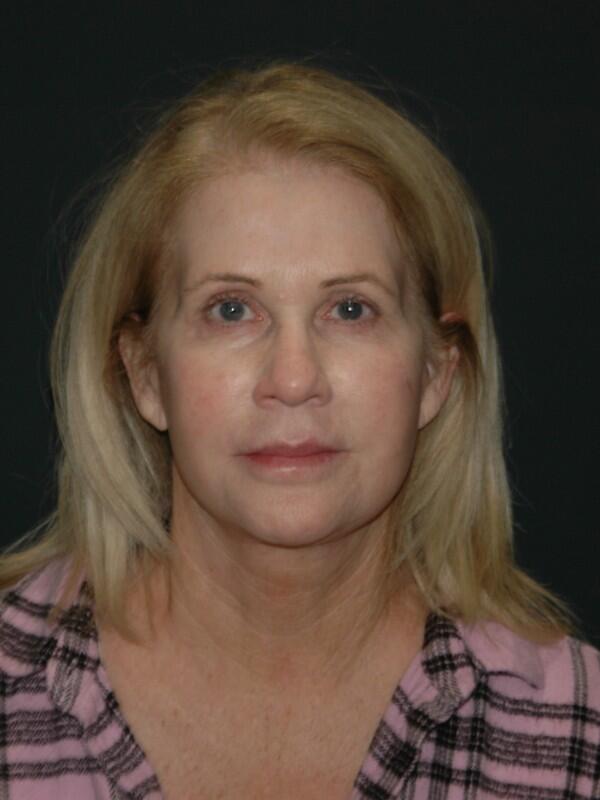 Facelift & Neck Lift Before & After Photo