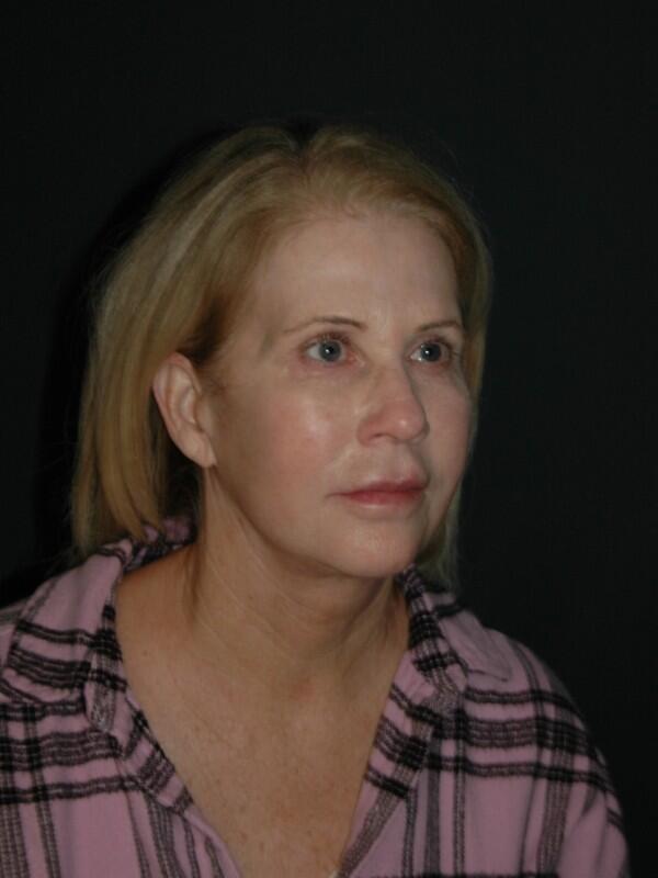 Facelift & Neck Lift Before & After Photo