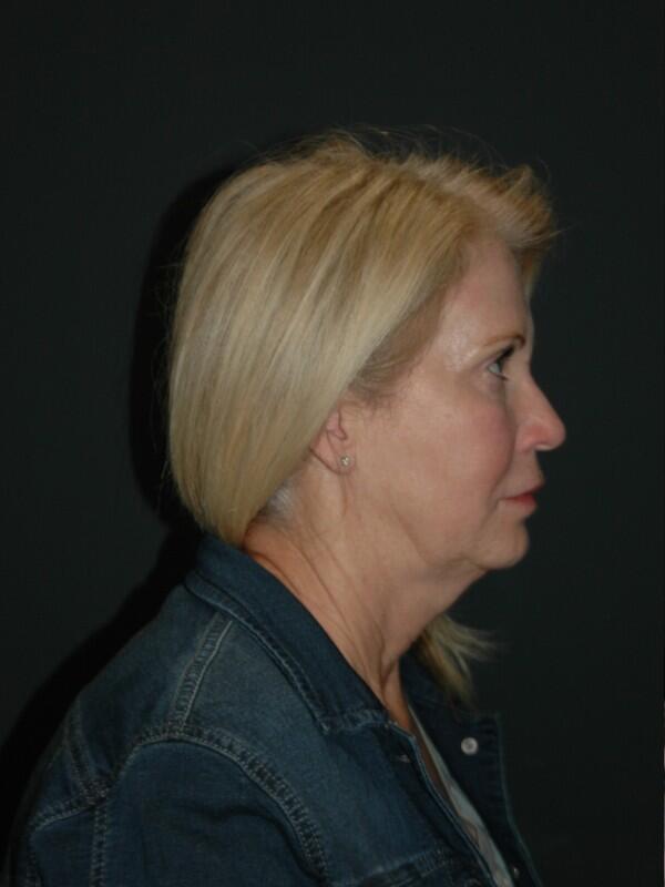 Facelift & Neck Lift Before & After Photo