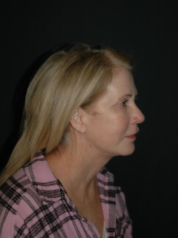 Facelift & Neck Lift Before & After Photo