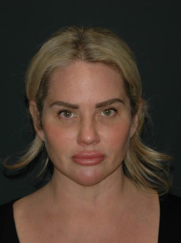 Facelift & Neck Lift Before & After Photo