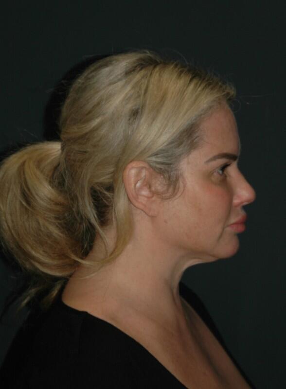 Facelift & Neck Lift Before & After Photo