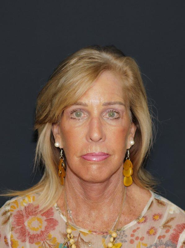 Facelift & Neck Lift Before & After Photo