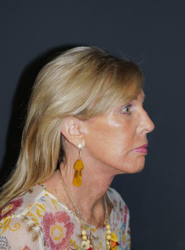 Facelift & Neck Lift Before & After Photo