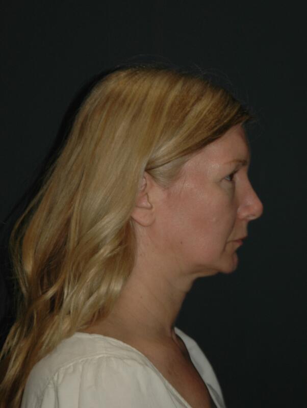 Facelift & Neck Lift Before & After Photo