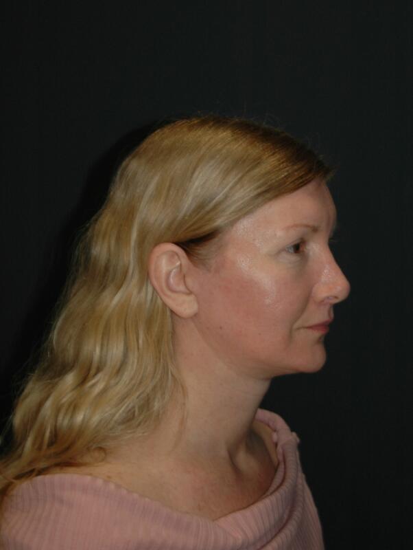 Facelift & Neck Lift Before & After Photo