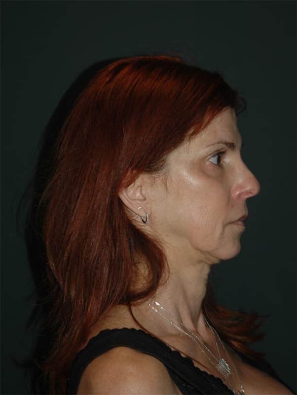 Facelift & Neck Lift Before & After Photo