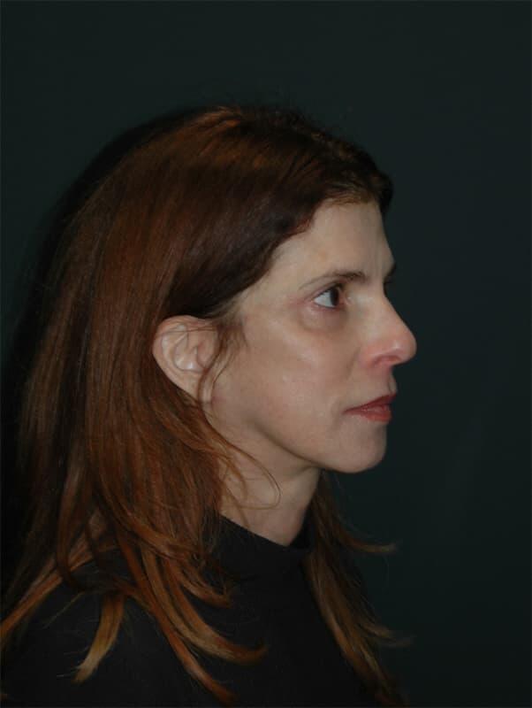 Facelift & Neck Lift Before & After Photo