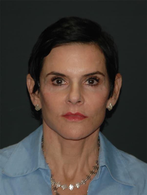 Facelift & Neck Lift Before & After Photo