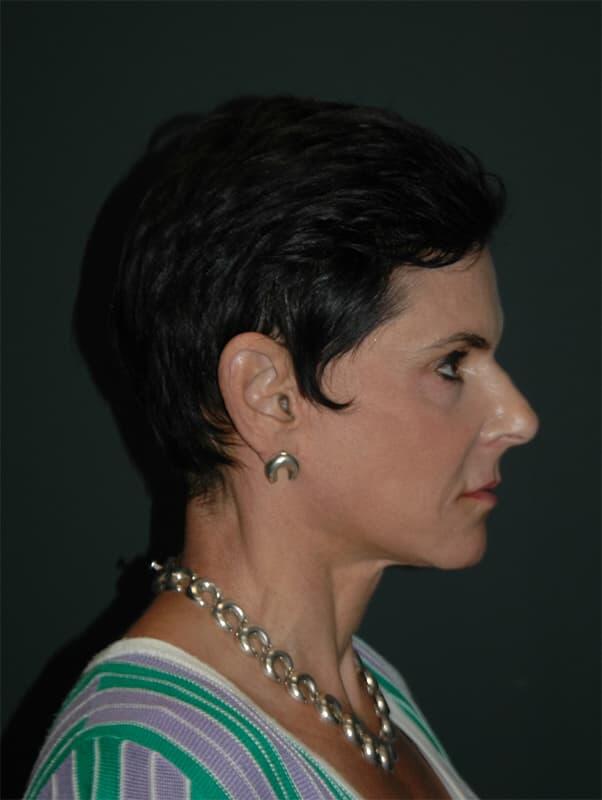 Facelift & Neck Lift Before & After Photo