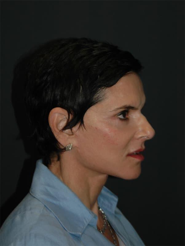 Facelift & Neck Lift Before & After Photo