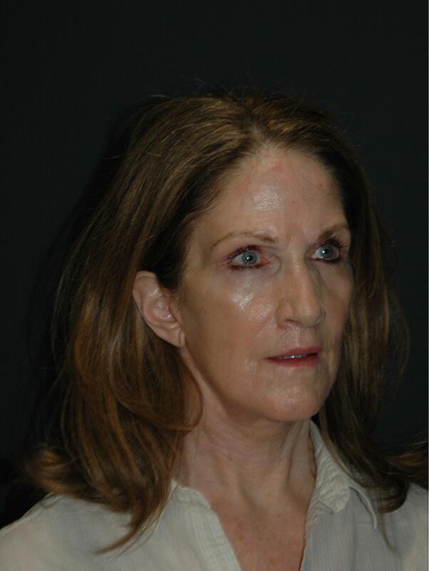 Facelift & Neck Lift Before & After Photo