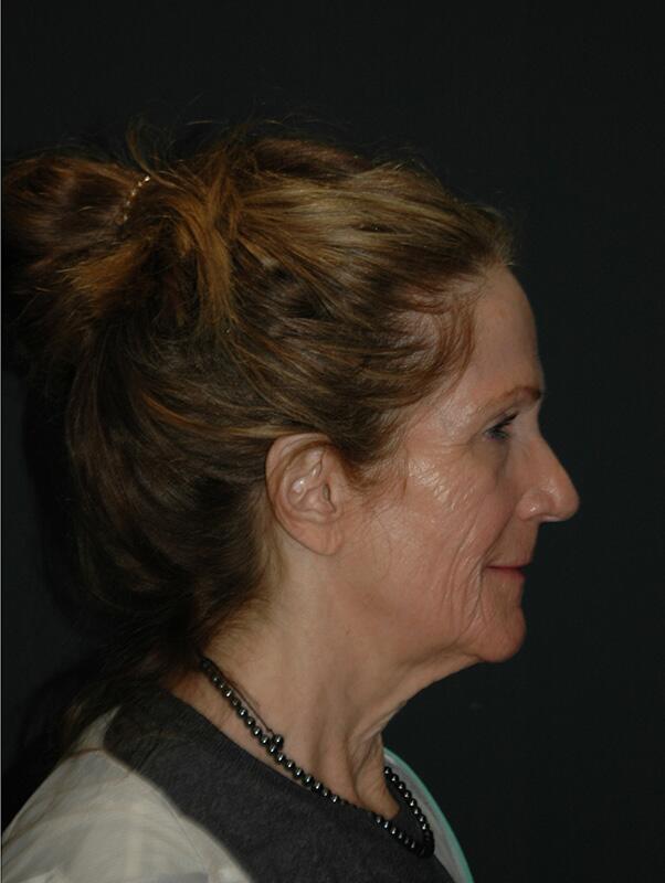 Facelift & Neck Lift Before & After Photo